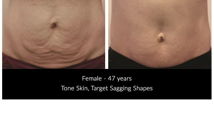 Stomach Transformation